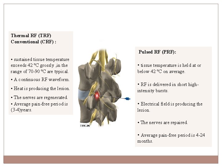 Thermal RF (TRF) Conventional (CRF) : Pulsed RF (PRF): • sustained tissue temperature exceeds