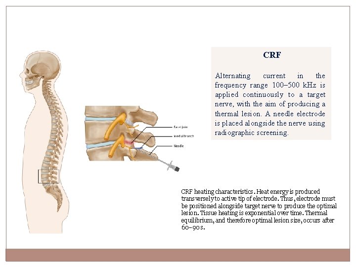 CRF Alternating current in the frequency range 100– 500 k. Hz is applied continuously