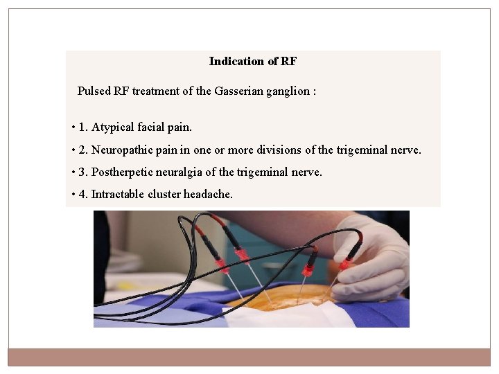 Indication of RF Pulsed RF treatment of the Gasserian ganglion : • 1. Atypical