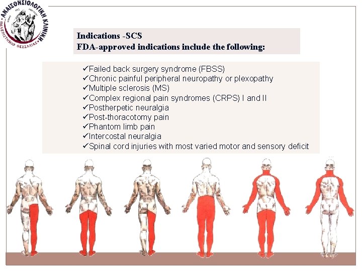 Indications -SCS FDA-approved indications include the following: üFailed back surgery syndrome (FBSS) üChronic painful