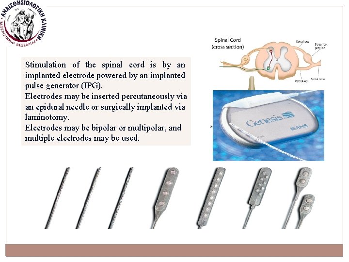 Stimulation of the spinal cord is by an implanted electrode powered by an implanted