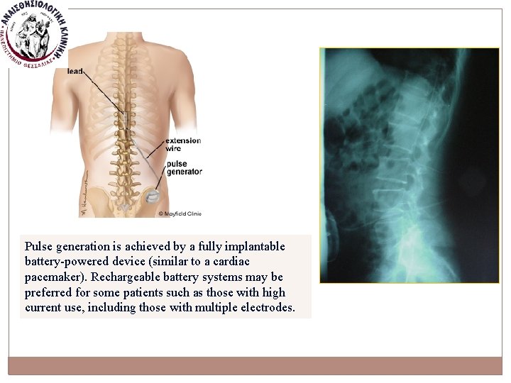 Pulse generation is achieved by a fully implantable battery-powered device (similar to a cardiac