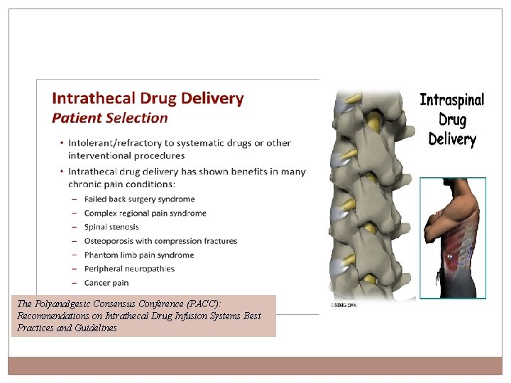 The Polyanalgesic Consensus Conference (PACC): Recommendations on Intrathecal Drug Infusion Systems Best Practices and