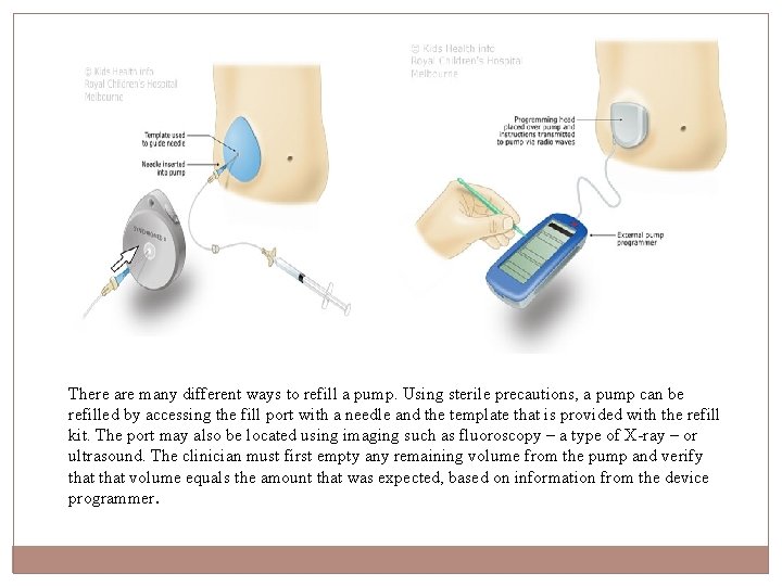 There are many different ways to refill a pump. Using sterile precautions, a pump