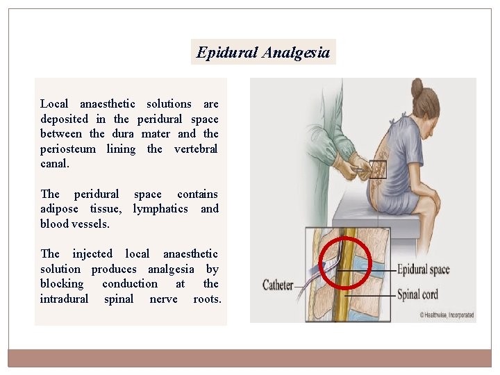 Epidural Analgesia Local anaesthetic solutions are deposited in the peridural space between the dura