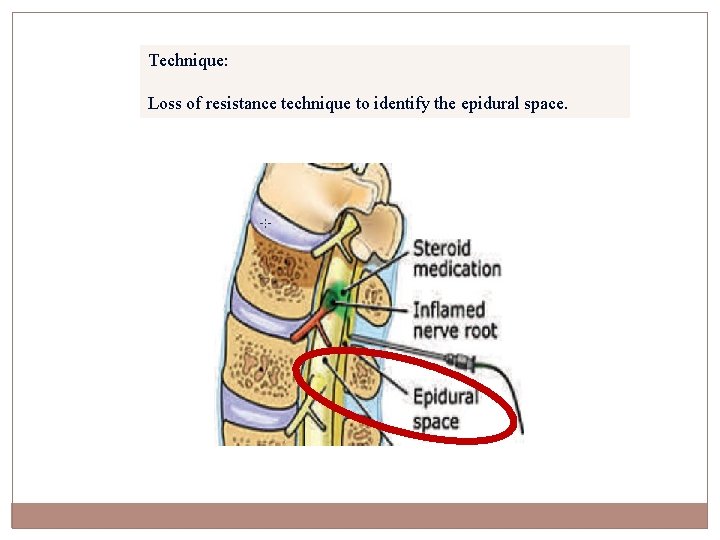 Technique: Loss of resistance technique to identify the epidural space. 