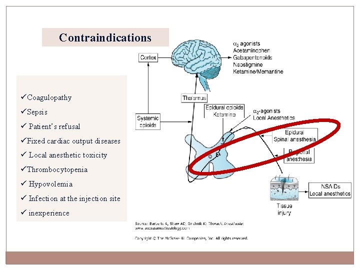 Contraindications üCoagulopathy üSepsis ü Patient’s refusal üFixed cardiac output diseases ü Local anesthetic toxicity