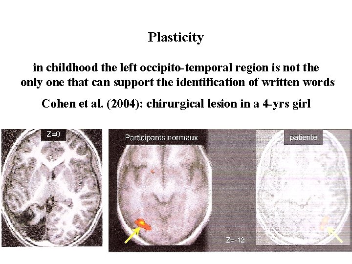 Plasticity in childhood the left occipito-temporal region is not the only one that can