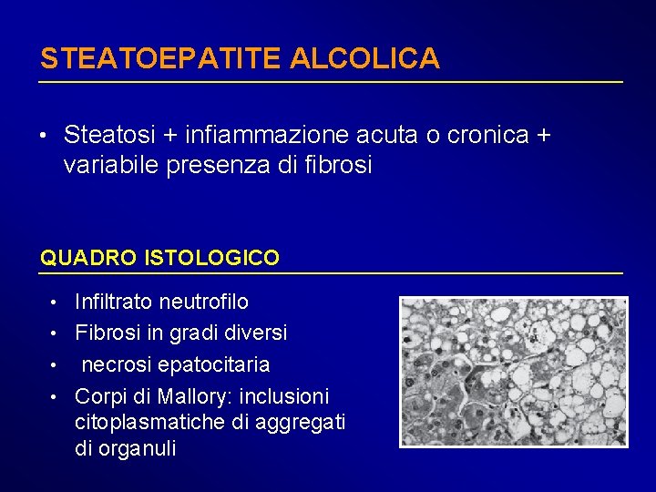 STEATOEPATITE ALCOLICA • Steatosi + infiammazione acuta o cronica + variabile presenza di fibrosi