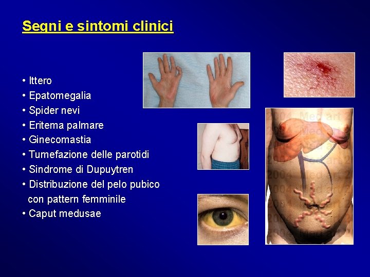 Segni e sintomi clinici • Ittero • Epatomegalia • Spider nevi • Eritema palmare