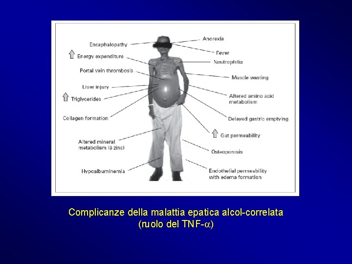 Complicanze della malattia epatica alcol-correlata (ruolo del TNF-a) 