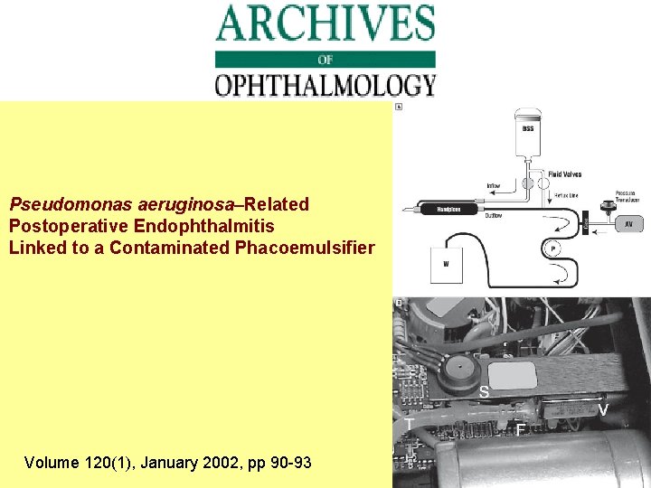 Pseudomonas aeruginosa–Related Postoperative Endophthalmitis Linked to a Contaminated Phacoemulsifier Volume 120(1), January 2002, pp