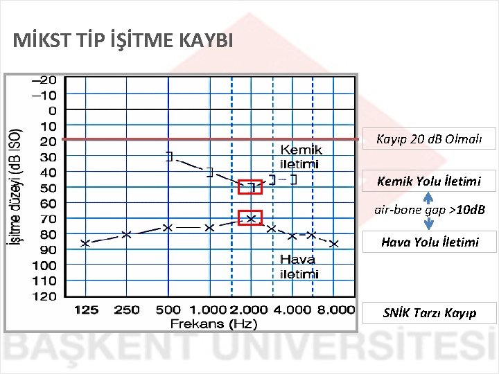 MİKST TİP İŞİTME KAYBI Kayıp 20 d. B Olmalı Kemik Yolu İletimi air-bone gap