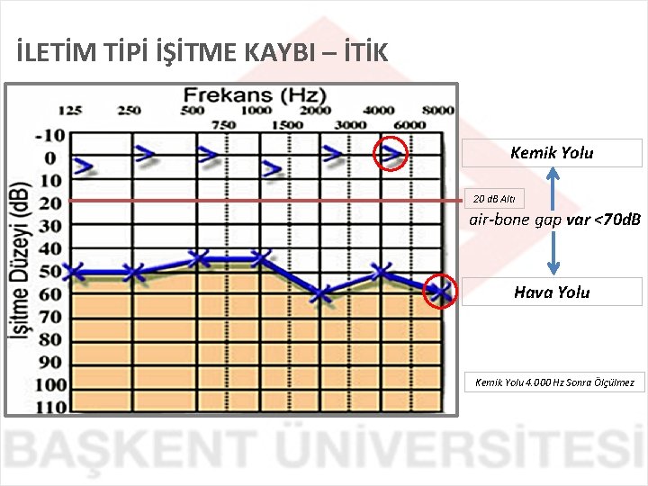 İLETİM TİPİ İŞİTME KAYBI – İTİK Kemik Yolu 20 d. B Altı air-bone gap