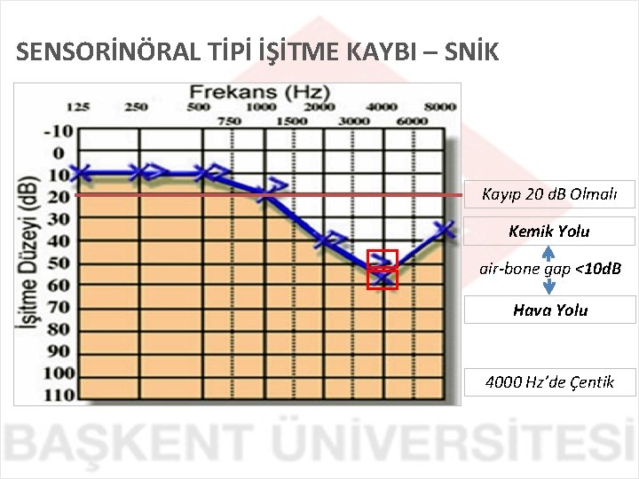 SENSORİNÖRAL TİPİ İŞİTME KAYBI – SNİK Kayıp 20 d. B Olmalı Kemik Yolu air-bone