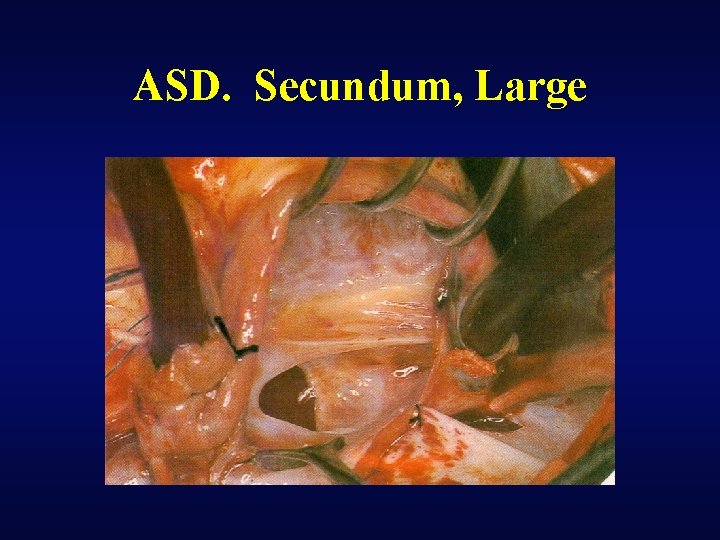 ASD. Secundum, Large 