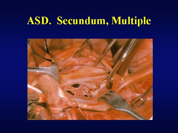 ASD. Secundum, Multiple 