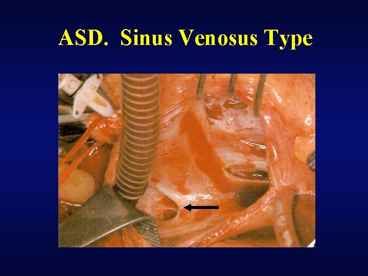 ASD. Sinus Venosus Type 