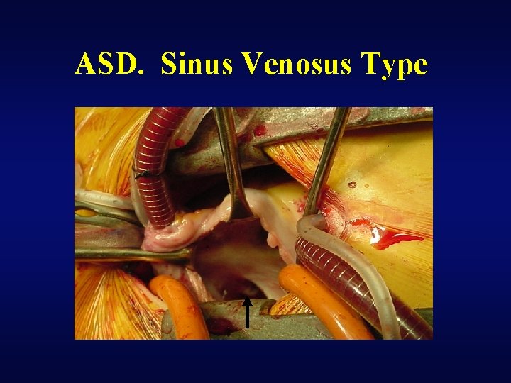 ASD. Sinus Venosus Type 