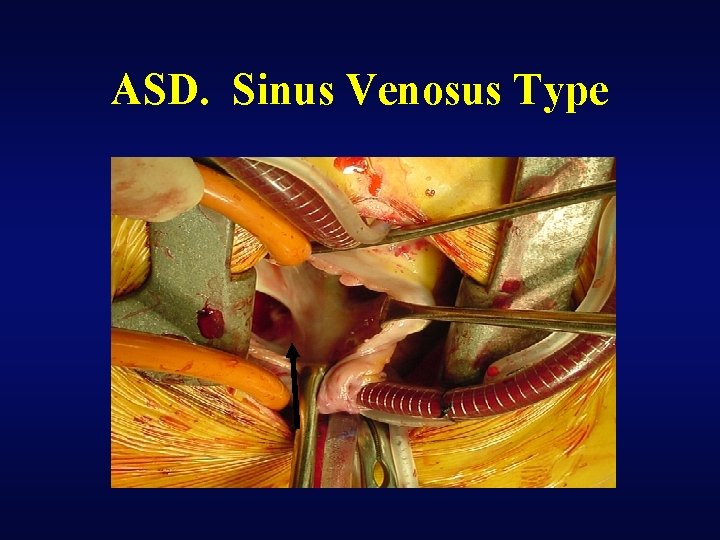 ASD. Sinus Venosus Type 