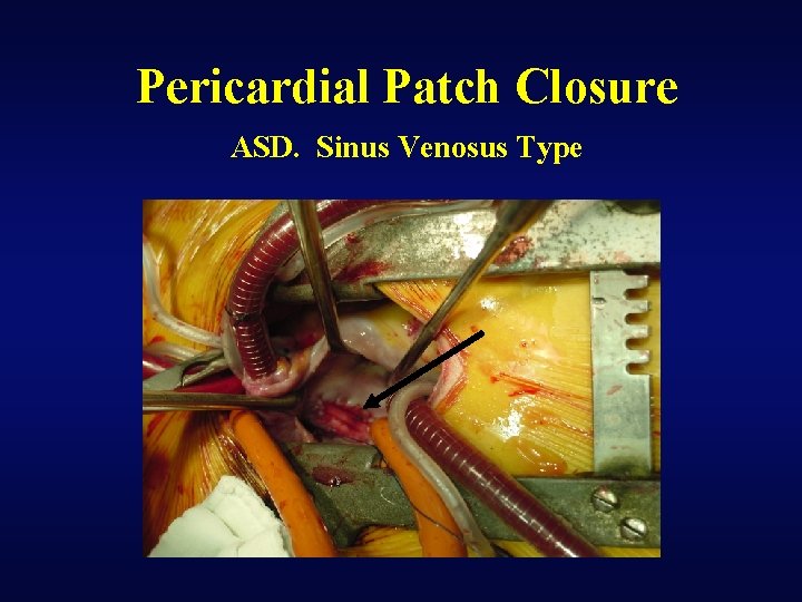 Pericardial Patch Closure ASD. Sinus Venosus Type 