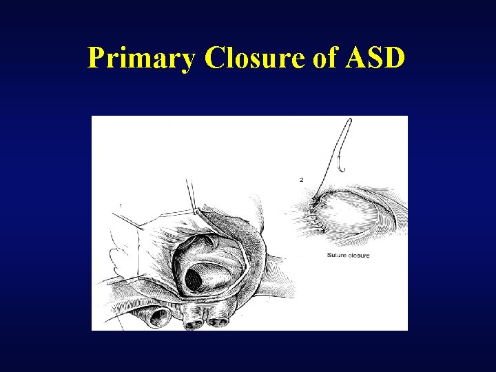 Primary Closure of ASD 