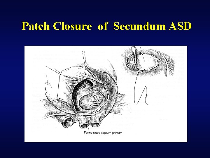Patch Closure of Secundum ASD 