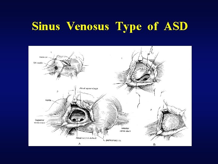 Sinus Venosus Type of ASD 