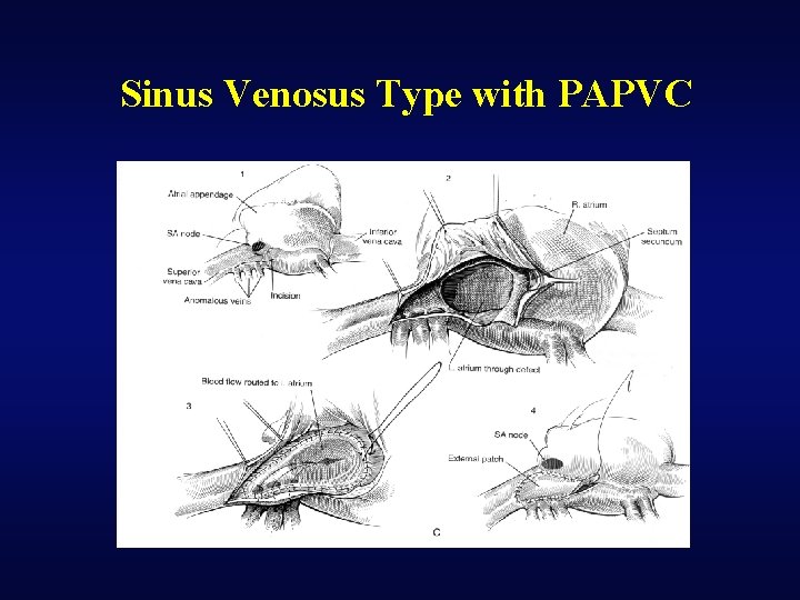 Sinus Venosus Type with PAPVC 