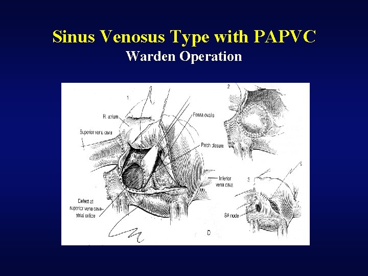 Sinus Venosus Type with PAPVC Warden Operation 