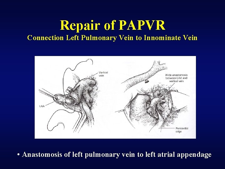 Repair of PAPVR Connection Left Pulmonary Vein to Innominate Vein • Anastomosis of left