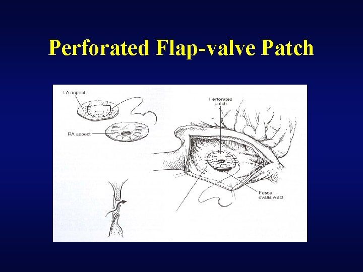 Perforated Flap-valve Patch 