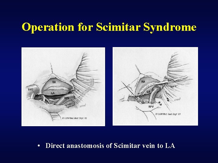 Operation for Scimitar Syndrome • Direct anastomosis of Scimitar vein to LA 