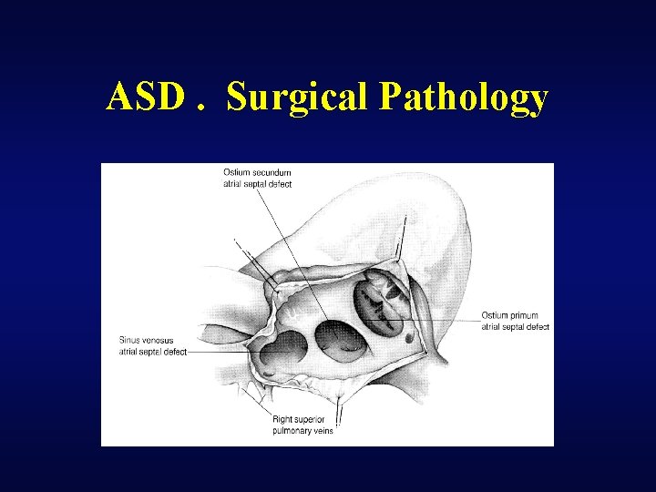 ASD. Surgical Pathology 