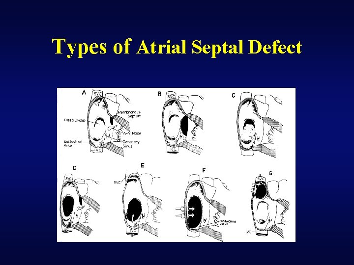 Types of Atrial Septal Defect 