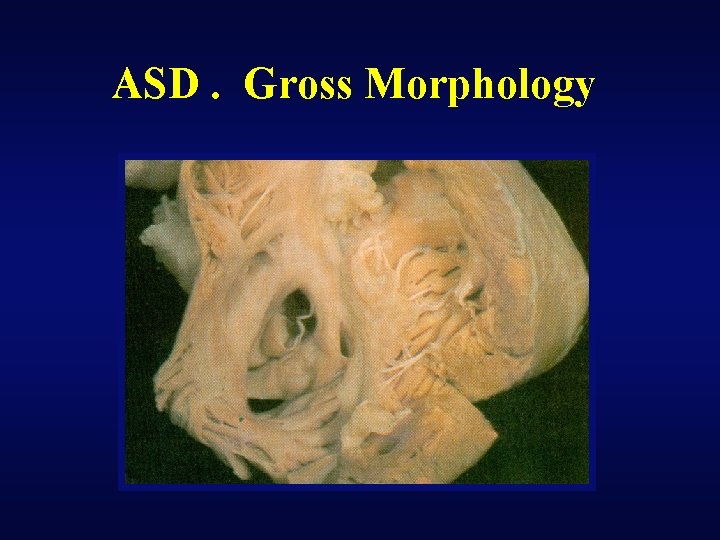 ASD. Gross Morphology 