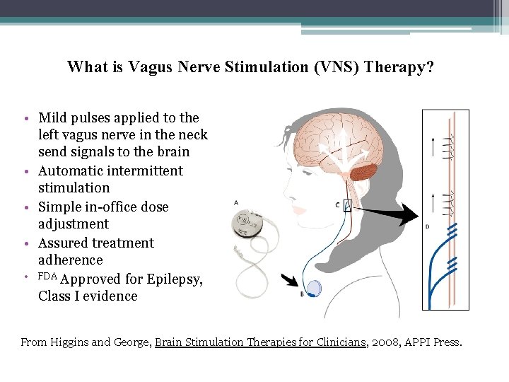 What is Vagus Nerve Stimulation (VNS) Therapy? • Mild pulses applied to the left