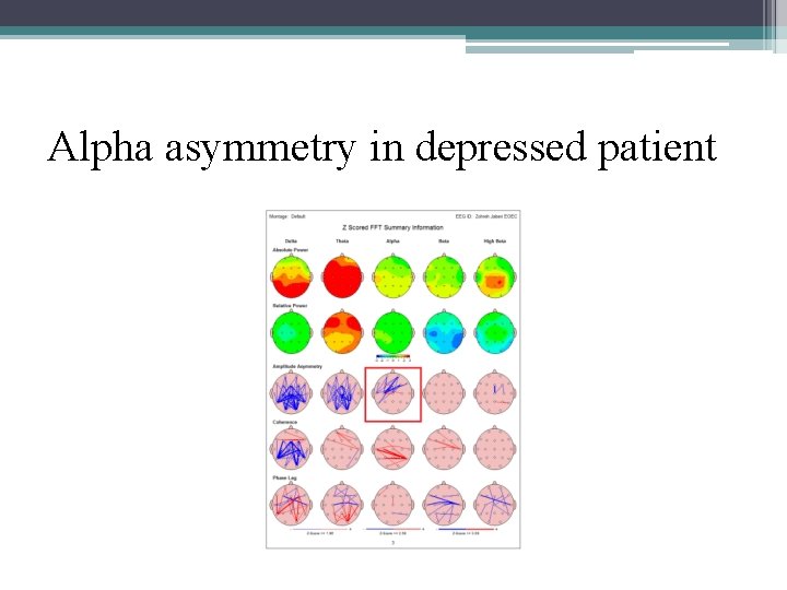 Alpha asymmetry in depressed patient 