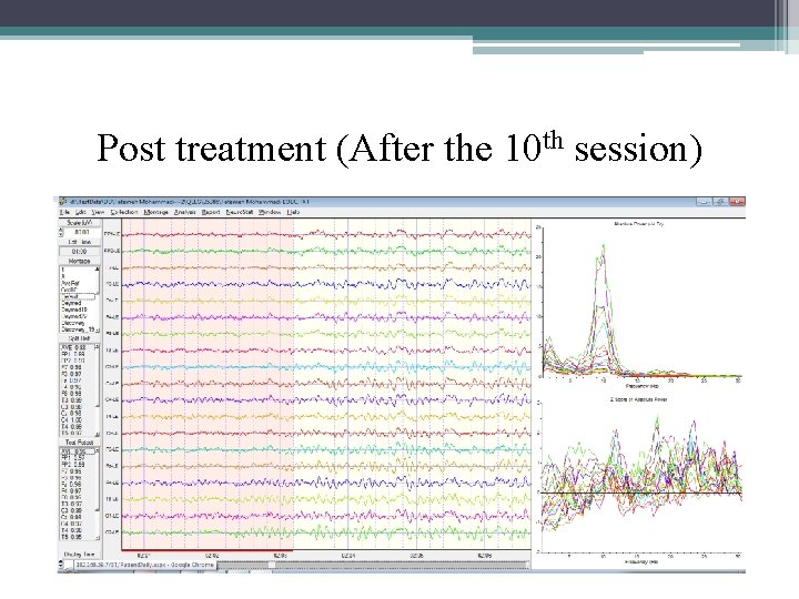 Post treatment (After the 10 th session) 