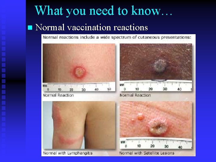 What you need to know… n Normal vaccination reactions 