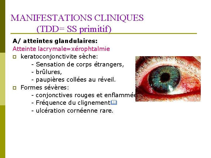 MANIFESTATIONS CLINIQUES (TDD= SS primitif) A/ atteintes glandulaires: Atteinte lacrymale=xérophtalmie p keratoconjonctivite sèche: -