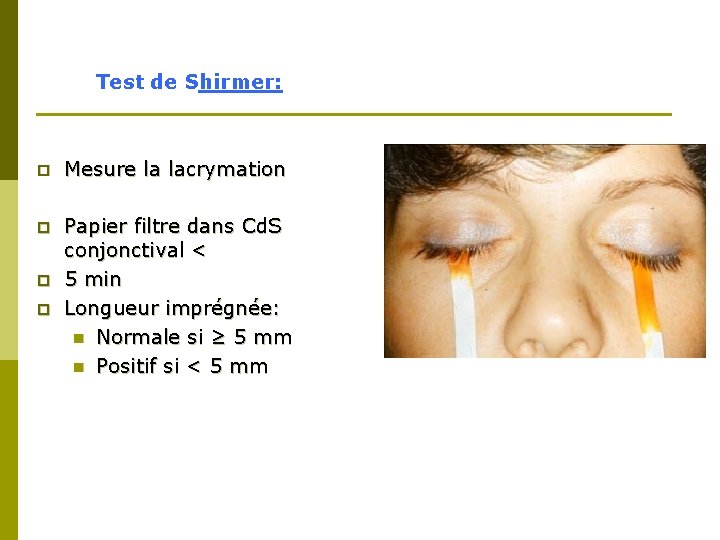 Test de Shirmer: p Mesure la lacrymation p Papier filtre dans Cd. S conjonctival