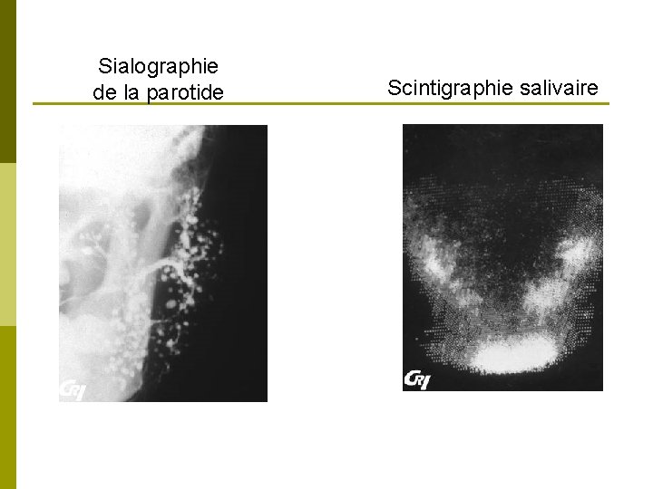 Sialographie de la parotide Scintigraphie salivaire 