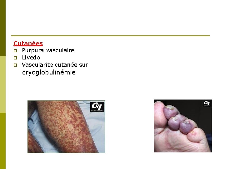 Cutanées p Purpura vasculaire p Livedo p Vascularite cutanée sur cryoglobulinémie 