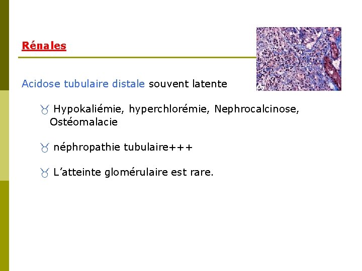 Rénales Acidose tubulaire distale souvent latente Hypokaliémie, hyperchlorémie, Nephrocalcinose, Ostéomalacie néphropathie tubulaire+++ L’atteinte glomérulaire