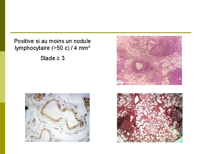 Positive si au moins un nodule lymphocytaire (>50 c) / 4 mm² Stade ≥