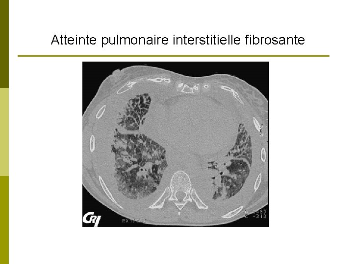 Atteinte pulmonaire interstitielle fibrosante 