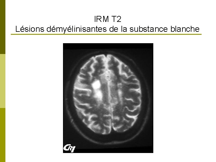 IRM T 2 Lésions démyélinisantes de la substance blanche 