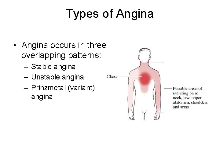 Types of Angina • Angina occurs in three overlapping patterns: – Stable angina –