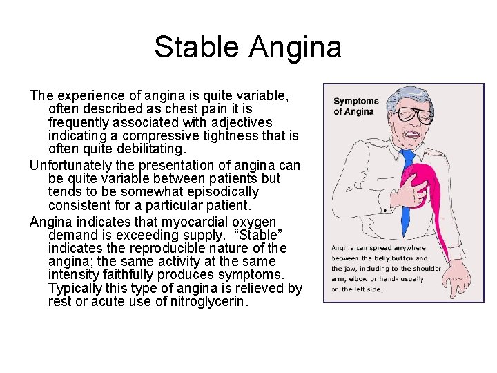 Stable Angina The experience of angina is quite variable, often described as chest pain